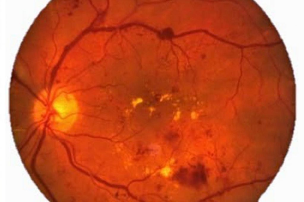 centro-de-oftalmolog-a-abreu-edema-macular-diab-tico-emd